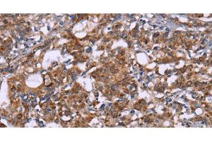 Immunohistochemistry of paraffin-embedded Human gastric cancer tissue using HSP10 Polyclonal Antibody at dilution 1:40 (HSPE1 antibody)