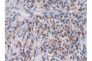 Detection of TGFb2 in Human Lung cancer Tissue using Polyclonal Antibody to Transforming Growth Factor Beta 2 (TGFb2) (TGFB2 antibody  (AA 303-414))