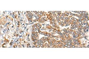 Immunohistochemistry of paraffin-embedded Human liver cancer tissue using EPHA6 Polyclonal Antibody at dilution of 1:40(x200) (EPH Receptor A6 antibody)