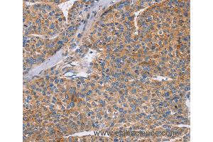 Immunohistochemistry of Human colon cancer using CDC7 Polyclonal Antibody at dilution of 1:70 (CDC7 antibody)