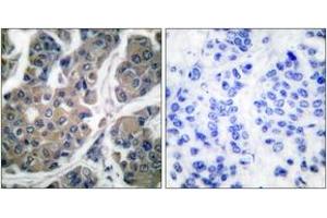 Immunohistochemistry analysis of paraffin-embedded human breast carcinoma, using eEF2 (Phospho-Thr56) Antibody. (EEF2 antibody  (pThr56))