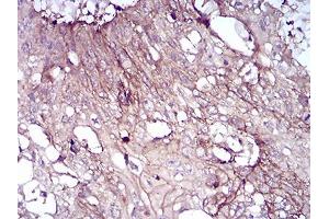 Immunohistochemical analysis of paraffin-embedded esophageal cancer tissues using CD6 mouse mAb with DAB staining. (CD6 antibody  (AA 18-199))