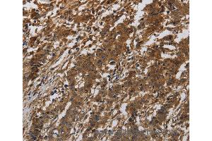 Immunohistochemistry of Human gastric cancer using ITGB7 Polyclonal Antibody at dilution of 1:40