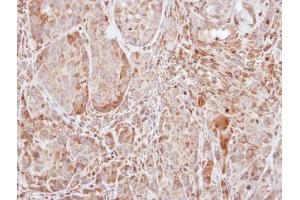 IHC-P Image Immunohistochemical analysis of paraffin-embedded A549 xenograft, using SOCS1, antibody at 1:100 dilution. (SOCS1 antibody  (C-Term))