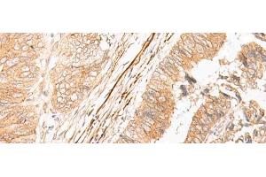 Immunohistochemistry of paraffin-embedded Human colorectal cancer tissue using EPS15 Polyclonal Antibody at dilution of 1:50(x200) (EPS15 antibody)