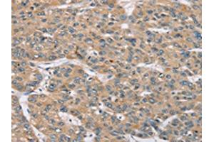 The image on the left is immunohistochemistry of paraffin-embedded Human liver cancer tissue using ABIN7192155(RBM38 Antibody) at dilution 1/35, on the right is treated with synthetic peptide. (RBM38 antibody)