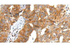 Immunohistochemistry of paraffin-embedded Human ovarian cancer tissue using SCT Polyclonal Antibody at dilution 1:40 (Secretin antibody)