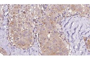 ABIN6273335 at 1/100 staining Human thyroid cancer tissue by IHC-P. (TRPC4AP antibody  (N-Term))