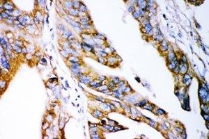 IHC-P: Claudin 2 antibody testing of human intestinal cancer tissue