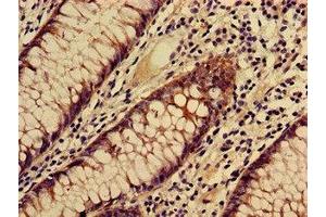Immunohistochemistry of paraffin-embedded human colon cancer using ABIN7171891 at dilution of 1:100 (Tspan-8 antibody  (AA 110-205))