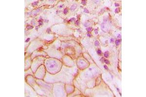 Immunohistochemical analysis of GPR105 staining in human breast cancer formalin fixed paraffin embedded tissue section. (P2RY14 antibody  (Center))