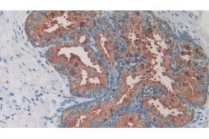 Detection of 0 in Human Prostate Tissue using Monoclonal Antibody to Amylin (Amylin/DAP antibody)