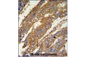 N3 Antibody (C-term) (ABIN651149 and ABIN2840100) IHC analysis in formalin fixed and raffin embedded human cervix carcinoma followed by peroxidase conjugation of the secondary antibody and DAB staining. (PAN3 antibody  (C-Term))