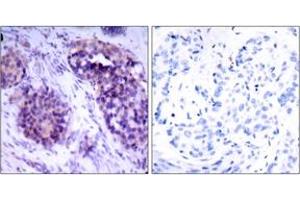 Immunohistochemistry analysis of paraffin-embedded human breast carcinoma tissue, using BCL-XL (Ab-62) Antibody. (BCL2L1 antibody  (AA 28-77))