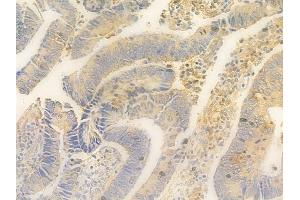 ABIN7095361 and ABIN7099418 at 1/100 staining human colon carcinoma by IHC-P. (ORMDL3 antibody)