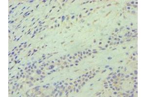 Immunohistochemistry of paraffin-embedded human breast cancer using ABIN7145117 at dilution of 1:100 (ATG9A antibody  (AA 180-290))