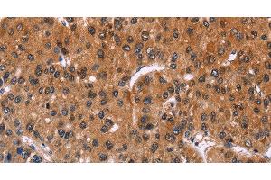 Immunohistochemistry of paraffin-embedded Human liver cancer using ING2 Polyclonal Antibody at dilution of 1:40 (ING2 antibody)
