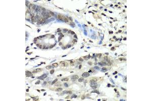 Immunohistochemistry of paraffin-embedded human gastric cancer using HIF1AN antibody (ABIN5973179) at dilution of 1/100 (40x lens). (HIF1AN antibody)