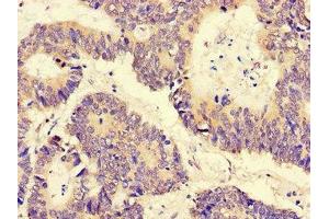 Immunohistochemistry of paraffin-embedded human colon cancer using ABIN7169300 at dilution of 1: 100 (PGAM5 antibody  (AA 30-223))