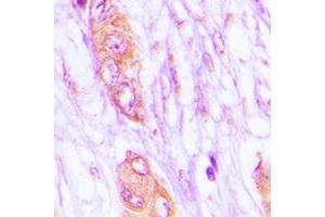 Immunohistochemical analysis of MELK staining in human lung cancer formalin fixed paraffin embedded tissue section.