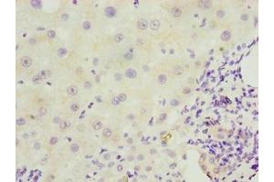 Immunohistochemistry of paraffin-embedded human liver cancer using ABIN7151406 at dilution of 1:100 (EFCAB12 antibody  (AA 1-200))