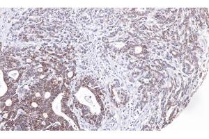 IHC-P Image Immunohistochemical analysis of paraffin-embedded human gastric cancer, using UBE2M, antibody at 1:100 dilution. (UBE2M antibody)