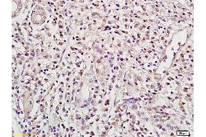 Formalin-fixed and paraffin embedded human gastric carcinoma labeled with Anti RBPJK RBP-J Polyclonal Antibody, unconjugated (ABIN872972) at 1:200 followed by incubation with conjugated secondary antibody and DAB staining