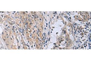 Immunohistochemistry of paraffin-embedded Human esophagus cancer tissue using MBL2 Polyclonal Antibody at dilution of 1:25(x200) (MBL2 antibody)