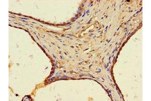 Immunohistochemistry of paraffin-embedded human prostate cancer using ABIN7175675 at dilution of 1:100 (WAP Four-Disulfide Core Domain 8 (WFDC8) (AA 44-94) antibody)