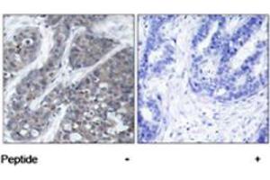 Immunohistochemical analysis of paraffin-embedded human breast carcinoma tissue using PTK2B polyclonal antibody  . (PTK2B antibody)