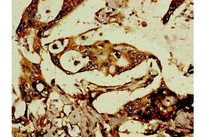 Immunohistochemistry of paraffin-embedded human pancreatic cancer using ABIN7167883 at dilution of 1:100 (Retrotransposon Gag-Like Protein 8B (RTL8C) (AA 1-113) antibody)