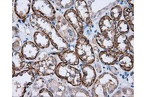 Immunohistochemical staining of paraffin-embedded Carcinoma of liver tissue using anti-RC201933 mouse monoclonal antibody. (PIM2 antibody)
