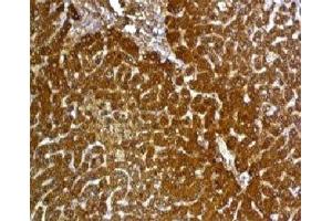 Formalin-fixed, paraffin-embedded human hepatocellular carcinoma stained with Glypican-3 antibody (GPC3/863)
