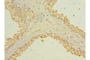 Immunohistochemistry of paraffin-embedded human prostate cancer using ABIN7173631 at dilution of 1:100 (TSACC/C1orf182 antibody  (AA 1-125))