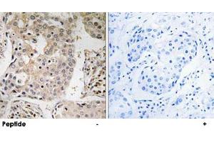 Immunohistochemistry analysis of paraffin-embedded human breast carcinoma tissue, using MRPL41 polyclonal antibody .