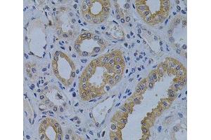 Immunohistochemistry of paraffin-embedded Human kidney cancer using MVP Polyclonal Antibody at dilution of 1:200 (40x lens). (MVP antibody)