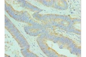 Immunohistochemistry of paraffin-embedded human colon cancer using ABIN7149525 at dilution of 1:100 (DCAF7 antibody  (AA 1-342))