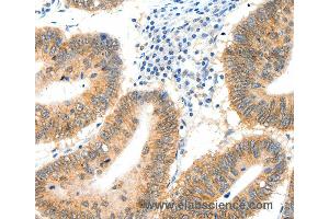 Immunohistochemistry of Human cervical cancer using SIPA1 Polyclonal Antibody at dilution of 1:40