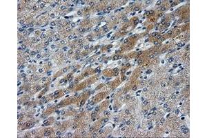 Immunohistochemical staining of paraffin-embedded Carcinoma of liver tissue using anti-LIPG mouse monoclonal antibody. (LIPG antibody)