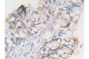 IHC-P analysis of Human Rectum Cancer Tissue, with DAB staining. (MSTN antibody  (AA 266-375))