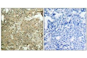 Immunohistochemical analysis of paraffin-embedded human breast carcinoma tissue using cofilin(Phospho-Ser3) Antibody(left) or the same antibody preincubated with blocking peptide(right). (Cofilin antibody  (pSer3))