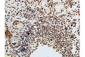 Formalin-fixed and paraffin embedded human colon carcinoma labeled with Anti-phospho-CDKN1A/P21 (Thr57) Polyclonal Antibody, Unconjugated (ABIN756877) at 1:200 followed by conjugation to the secondary antibody (p21 antibody  (pThr57))
