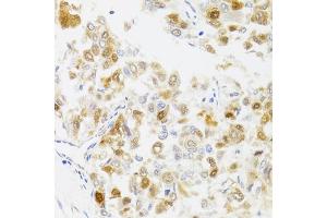 Immunohistochemistry of paraffin-embedded human liver cancer using MYO5A antibody.