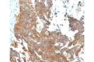 Formalin-fixed, paraffin-embedded human ovarian carcinoma stained with GnRH Receptor antibody (GNRHR/768) (GNRHR antibody)