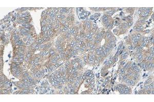 ABIN6276702 at 1/100 staining Human cervical cancer tissue by IHC-P. (NQO1 antibody  (C-Term))