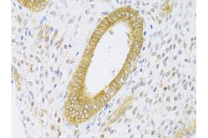 Immunohistochemistry of paraffin-embedded human adenomyosis using RAB27A Antibody (ABIN5970998) at dilution of 1/100 (40x lens). (RAB27A antibody)
