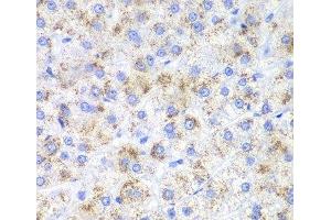 Immunohistochemistry of paraffin-embedded Human liver cancer using HAO1 Polyclonal Antibody at dilution of 1:200 (40x lens).