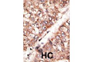 Formalin-fixed and paraffin-embedded human hepatocellular carcinoma tissue reacted with BMP3 polyclonal antibody  , which was peroxidase-conjugated to the secondary antibody, followed by AEC staining. (BMP3 antibody  (N-Term))