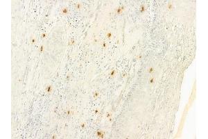 ABIN6261092 and ABIN6277988 at 1/100 staining human cervical carcinoma by IHC-P.
