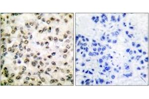 Immunohistochemistry analysis of paraffin-embedded human breast carcinoma tissue, using CREB-BP Antibody.